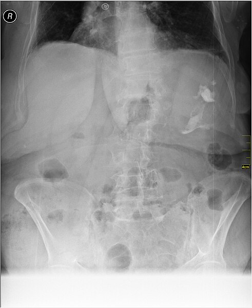 File:Medical X-Ray imaging XIH07 nevit.jpg