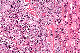 Medullary thyroid cancer Malignant thyroid neoplasm originating from C-cells