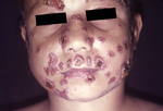Paracoccidioidomycosis lesions.png