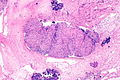 Sarcoidosis lung - low mag.