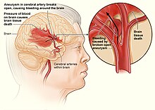 Stroke hemorrhagic.jpg