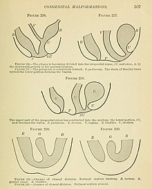 A 1904 gynecology textbook that describes some vaginal anomalies The Principles and practice of gynecology - for students and practitioners (1904) (14581562657).jpg