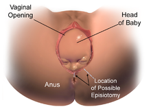Episiotomy - Wikipedia