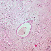 Classic Invasive Lobular Carcinoma of the Breast (6813147258).jpg