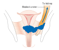 Stage 3B cervical cancer