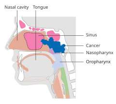 Stage T3 nasopharyngeal cancer