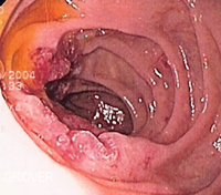 Endoscopic image of adenocarcinoma of duodenum seen in the post-bulbar duodenum.