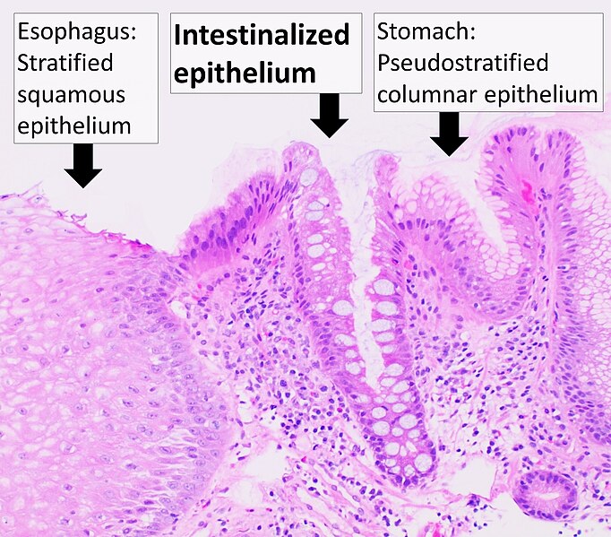 File:Histopathology of Barrett's esophagus, annotated.jpg