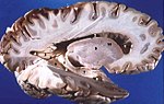 Sagittalschnitt des Gehirns: Graue Substanz außen und Weiße Substanz innen.