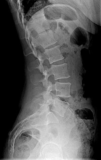 X-ray of lumbar hyperlordosis