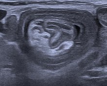 An ultrasound shows a target sign--characteristic for intussusception Invagination Sonografie.jpg