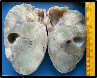 Krukenberg tumor Human disease