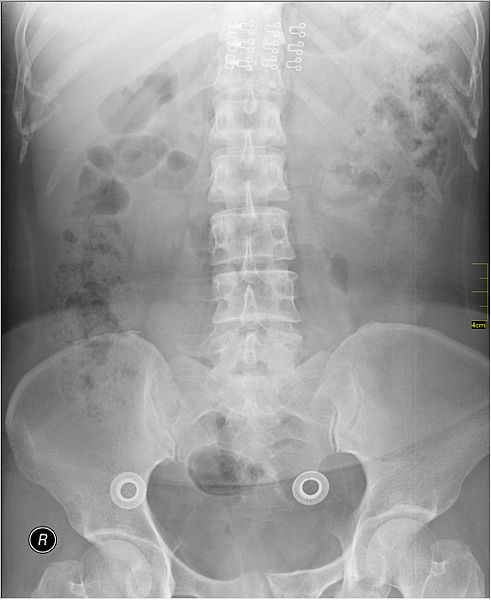 File:Medical X-Ray imaging OHV06 nevit.jpg