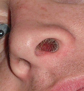 <span class="mw-page-title-main">Nasal hair</span> Adult humans have hair in the nostrils