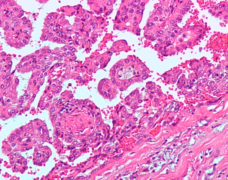 File:Papillary renal cell carcinoma 1.jpg