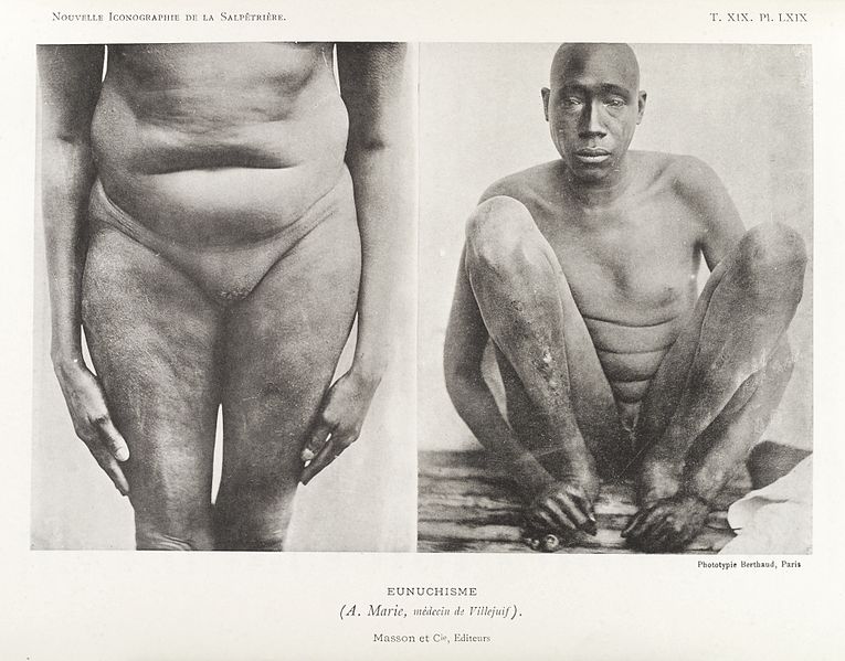 Датотека:Photos of man suffering from condition called 'Eunuchism' Wellcome L0034952.jpg