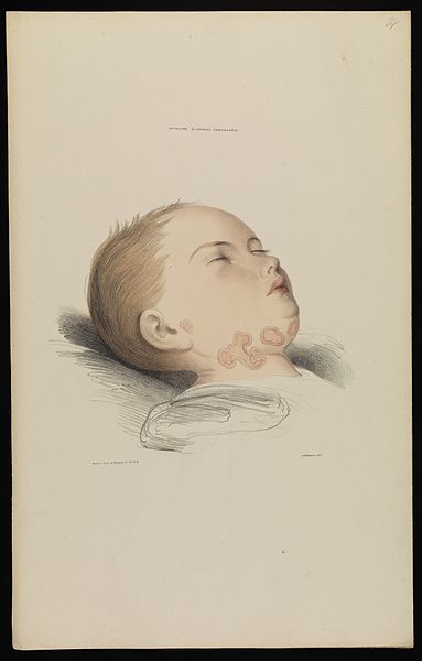 File:Syphilida, psoriasis orbicularis, baby, Robert Willis, 1841 Wellcome L0074332.jpg