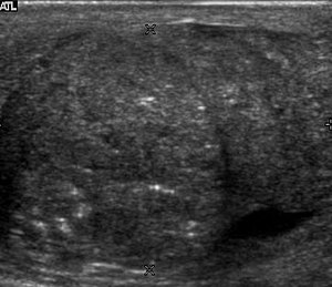 Scrotal Ultrasound