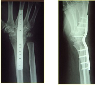 Die Arthrodese ist eine operat