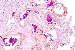 صورة مجهرية of an arteriovenous malformation in the brain. HPS stain.