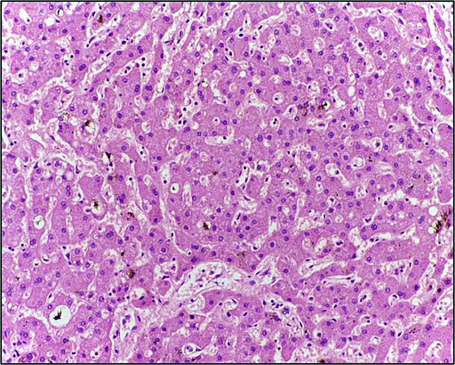 Bilirubin pigment in cholestatic liver