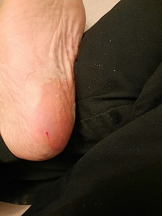 Painful cut (left heel) as a result of using callus shaver CallusShaverCut.jpg