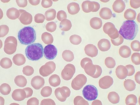 مسحة الدم المحيطي تظهر خلايا CLL