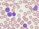 Chronic lymphocytic leukemia