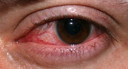 CLARE (contact lens associated red eye) is a group of inflammatory complications from lens wear