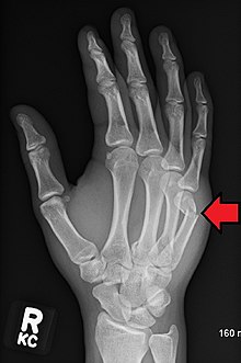 Boxer s fracture Wikipedia