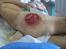 pressure ulcer stage 1 foot