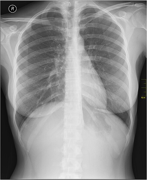 File:Medical X-Ray imaging OTN06 nevit.jpg