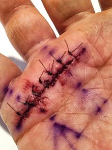 Post operative photo of trigger finger release surgery in a diabetic patient. See: Post-operative photo of trigger finger release surgery.jpg