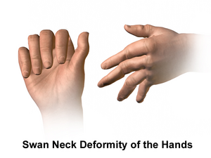 Rheumatoid Arthritis (Swan Neck Deformity)