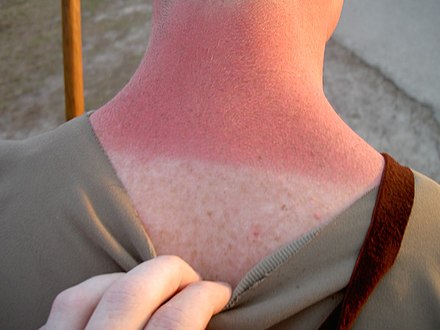 A sunburnt neck