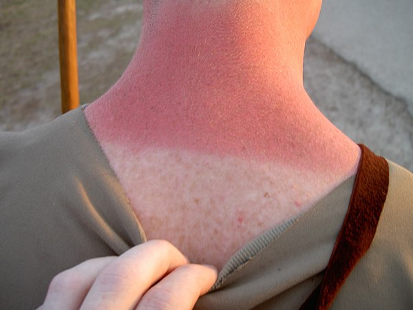 A sunburned neck