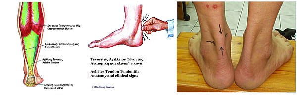 Achilles tendon