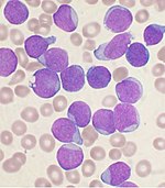 A Wright's-stained bone marrow aspirate smear from a patient with leukemia Acute leukemia-ALL.jpg