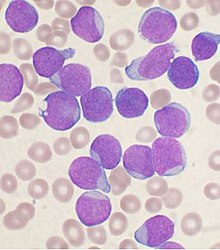 Acute leukemia-ALL.jpg