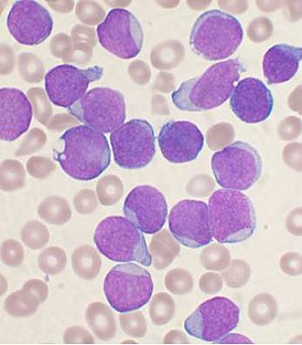 Micropreparazione del midollo osseo di un paziente con leucemia leucoblastica linfocitica B acuta