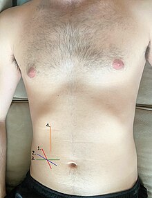 Four incisions for an appendectomy, corresponding to the order listed. Appendectomy incision locations.jpg
