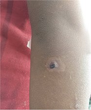 Hypopigmentation and an crusted erosion, elbow of a 5-year-old