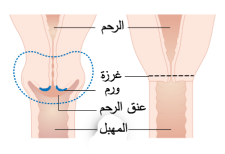 Diagram showing the parts removed with trachelectomy surgery CRUK 338-ar.png