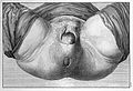 External - vagina with baby's head appearing. Wellcome L0016372.jpg