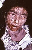 Eine italienische Pockenpatientin, deren Haut die Merkmale einer konfluierenden makulopapulösen Narbenbildung im Spätstadium aufwies, 1965.