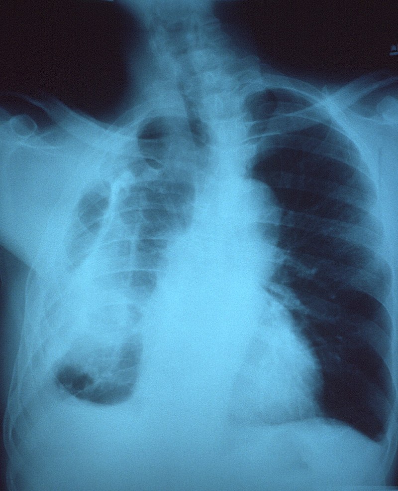 Fibrothorax chest x-ray.jpg