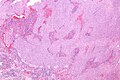 Glassy cell carcinoma - low mag.jpg