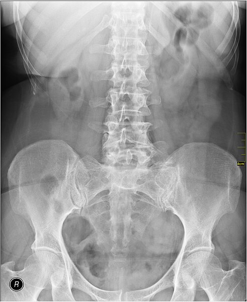 File:Medical X-Ray imaging CWN03 nevit.jpg