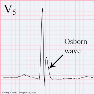 An Osborn wave, an abnormal EKG tracing that can be associated with hypercalcemia.