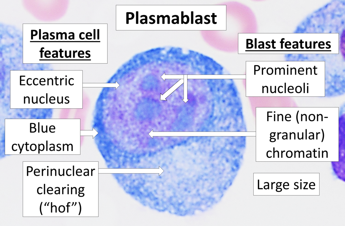 Lymphoid neoplasms with plasmablastic differentiation